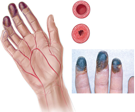 Viêm tắc động mạch ở ngón tay