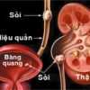 Bệnh sỏi thận và cách điều trị