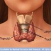 Phương pháp hỗ trợ điều trị bệnh bướu cổ