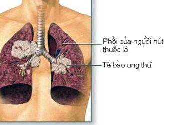 Bướu ung thư trong phổi