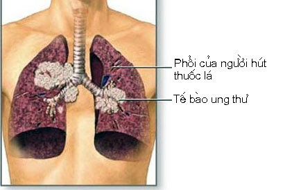 Bướu ung thư trong phổi