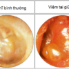 Chữa viêm tai giữa
